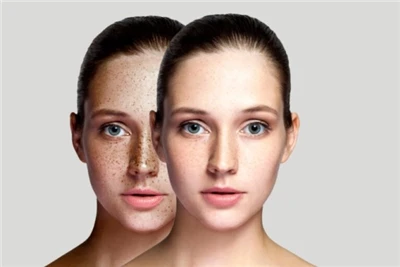 Te maimoatanga whai hua mo te Melasma: Ka taea e enei Hangarau Ake e toru te ...